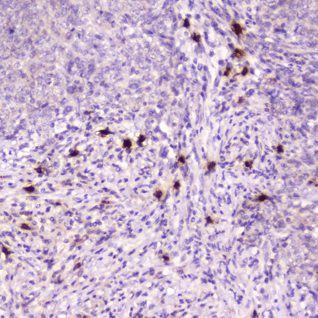 RNASE3 Antibody - IHC analysis of Ribonuclease 3 using anti-Ribonuclease 3 antibody. Ribonuclease 3 was detected in paraffin-embedded section of human sarcoma tissue . Heat mediated antigen retrieval was performed in citrate buffer (pH6, epitope retrieval solution) for 20 mins. The tissue section was blocked with 10% goat serum. The tissue section was then incubated with 2µg/ml rabbit anti-Ribonuclease 3 Antibody overnight at 4°C. Biotinylated goat anti-rabbit IgG was used as secondary antibody and incubated for 30 minutes at 37°C. The tissue section was developed using Strepavidin-Biotin-Complex (SABC) with DAB as the chromogen.