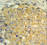 RNASEK Antibody - RNASEK Antibody IHC of formalin-fixed and paraffin-embedded human prostate carcinoma followed by peroxidase-conjugated secondary antibody and DAB staining.