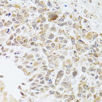 RNASEL / RNase L Antibody - Immunohistochemistry of paraffin-embedded human lung cancer tissue.