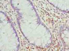 RNF10 Antibody - Immunohistochemistry of paraffin-embedded human colon cancer using antibody at dilution of 1:100.