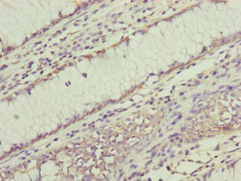 RNF11 Antibody - Immunohistochemistry of paraffin-embedded human colon cancer at dilution of 1:100