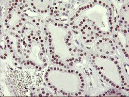 RNF113B Antibody - IHC of paraffin-embedded Carcinoma of Human thyroid tissue using anti-RNF113B mouse monoclonal antibody. (Heat-induced epitope retrieval by 10mM citric buffer, pH6.0, 100C for 10min).