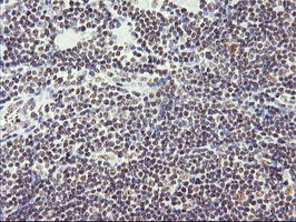 RNF113B Antibody - IHC of paraffin-embedded Human lymphoma tissue using anti-RNF113B mouse monoclonal antibody. (Heat-induced epitope retrieval by 10mM citric buffer, pH6.0, 100C for 10min).