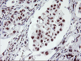 RNF113B Antibody - IHC of paraffin-embedded Carcinoma of Human lung tissue using anti-RNF113B mouse monoclonal antibody.