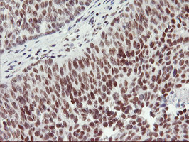 RNF113B Antibody - IHC of paraffin-embedded Carcinoma of Human bladder tissue using anti-RNF113B mouse monoclonal antibody.