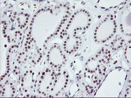 RNF113B Antibody - IHC of paraffin-embedded Carcinoma of Human thyroid tissue using anti-RNF113B mouse monoclonal antibody.