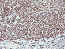 RNF113B Antibody - IHC of paraffin-embedded Adenocarcinoma of Human ovary tissue using anti-RNF113B mouse monoclonal antibody.