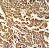 RNF114 / ZNF313 Antibody - ZNF313 Antibody immunohistochemistry of formalin-fixed and paraffin-embedded human skin carcinoma followed by peroxidase-conjugated secondary antibody and DAB staining.