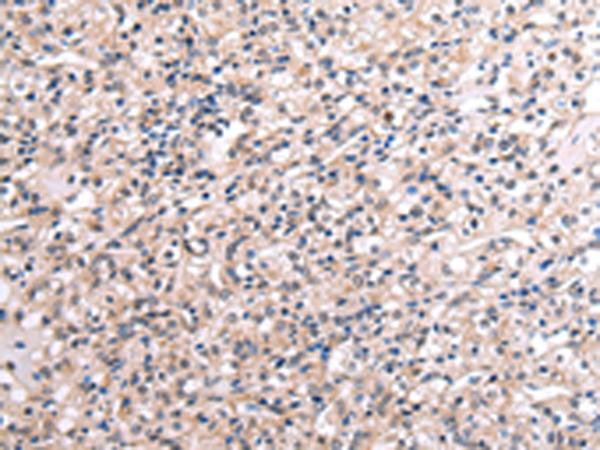 RNF115 / BCA2 Antibody - Immunohistochemistry of paraffin-embedded Human liver cancer tissue  using RNF115 Polyclonal Antibody at dilution of 1:45(×200)