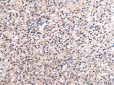 RNF115 / BCA2 Antibody - Immunohistochemistry of paraffin-embedded Human liver cancer tissue  using RNF115 Polyclonal Antibody at dilution of 1:45(×200)