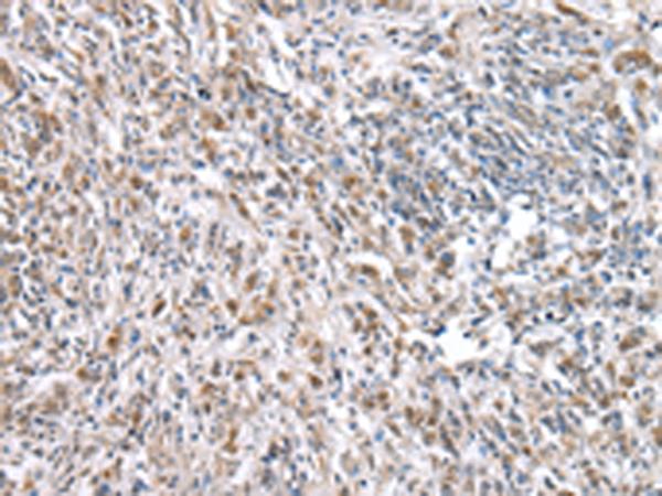 RNF115 / BCA2 Antibody - Immunohistochemistry of paraffin-embedded Human prost ate cancer tissue  using RNF115 Polyclonal Antibody at dilution of 1:45(×200)