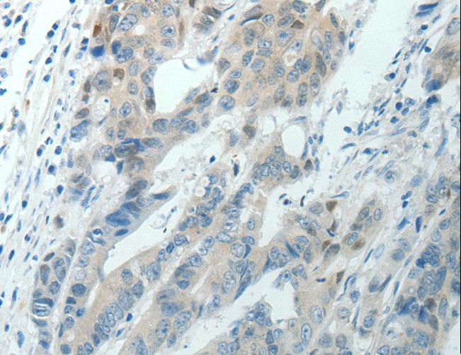 RNF126 Antibody - Immunohistochemistry of paraffin-embedded Human colon cancer using RNF126 Polyclonal Antibody at dilution of 1:70.