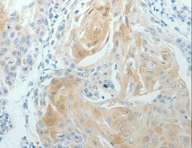 RNF126 Antibody - Immunohistochemistry of paraffin-embedded Human cervical cancer using RNF126 Polyclonal Antibody at dilution of 1:70.