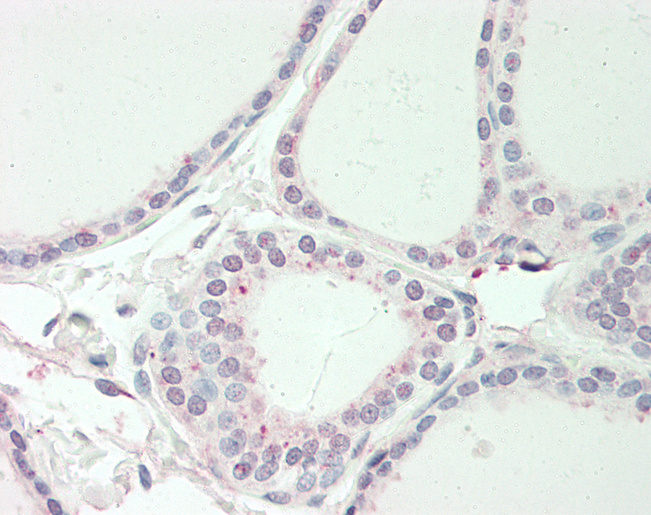 RNF13 Antibody - Human Thyroid: Formalin-Fixed, Paraffin-Embedded (FFPE).  This image was taken for the unconjugated form of this product. Other forms have not been tested.