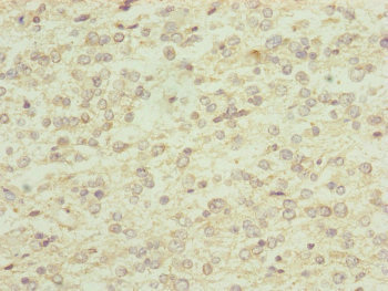 RNF13 Antibody - Immunohistochemistry of paraffin-embedded human glioma cancer at dilution of 1:100