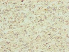 RNF13 Antibody - Immunohistochemistry of paraffin-embedded human glioma cancer at dilution of 1:100