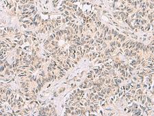 RNF13 Antibody - Immunohistochemistry of paraffin-embedded Human ovarian cancer tissue  using RNF13 Polyclonal Antibody at dilution of 1:60(×200)