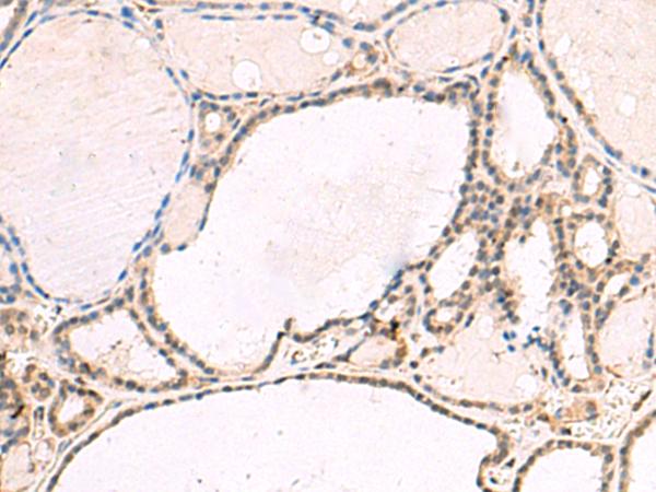 RNF13 Antibody - Immunohistochemistry of paraffin-embedded Human thyroid cancer tissue  using RNF13 Polyclonal Antibody at dilution of 1:60(×200)