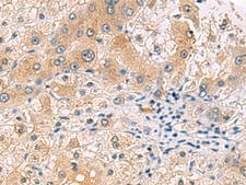 RNF13 Antibody - Immunohistochemistry of paraffin-embedded Human liver cancer tissue  using RNF13 Polyclonal Antibody at dilution of 1:60(×200)