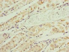 RNF135 Antibody - Immunohistochemistry of paraffin-embedded human gastric cancer at dilution of 1:100