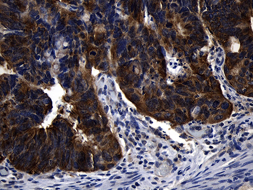 RNF14 / ARA54 Antibody - Immunohistochemical staining of paraffin-embedded Adenocarcinoma of Human colon tissue using anti-RNF14 mouse monoclonal antibody. (Heat-induced epitope retrieval by 1mM EDTA in 10mM Tris buffer. (pH8.5) at 120°C for 3 min. (1:500)