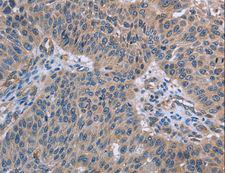 RNF144B Antibody - Immunohistochemistry of paraffin-embedded Human lung cancer using RNF144B Polyclonal Antibody at dilution of 1:50.