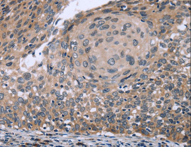 RNF144B Antibody - Immunohistochemistry of paraffin-embedded Human cervical cancer using RNF144B Polyclonal Antibody at dilution of 1:50.