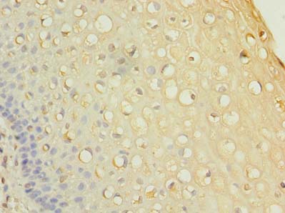RNF148 Antibody - Immunohistochemistry of paraffin-embedded human cervical cancer using antibody at dilution of 1:100.
