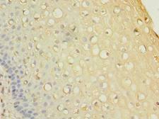 RNF148 Antibody - Immunohistochemistry of paraffin-embedded human cervical cancer using antibody at dilution of 1:100.