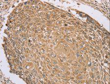 RNF148 Antibody - Immunohistochemistry of paraffin-embedded Human cervical cancer using RNF148 Polyclonal Antibody at dilution of 1:45.