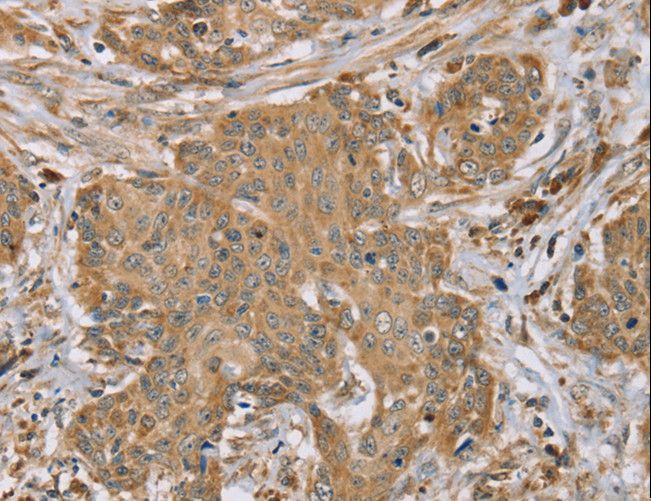 RNF148 Antibody - Immunohistochemistry of paraffin-embedded Human cervical cancer using RNF148 Polyclonal Antibody at dilution of 1:45.