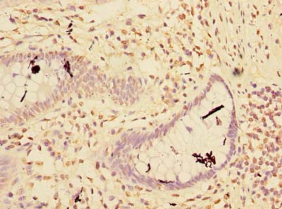 RNF181 Antibody - Immunohistochemistry of paraffin-embedded human colon cancer using antibody at dilution of 1:100.