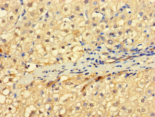 RNF182 Antibody - Immunohistochemistry of paraffin-embedded human liver cancer using RNF182 Antibody at dilution of 1:100