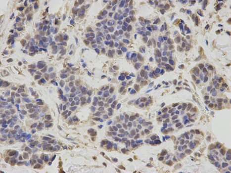 RNF2 / RING2 / RING1B Antibody - Immunohistochemistry of paraffin-embedded human breast cancer using RNF2 antibody at dilution of 1:200 (400x lens).