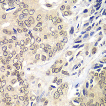 RNF2 / RING2 / RING1B Antibody - Immunohistochemistry of paraffin-embedded human prostate cancer tissue.