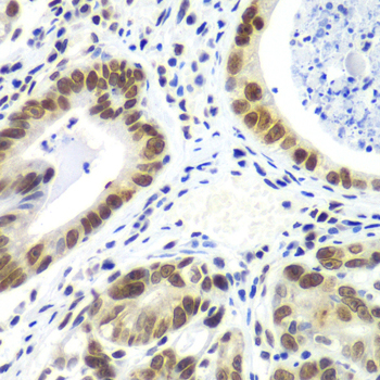 RNF2 / RING2 / RING1B Antibody - Immunohistochemistry of paraffin-embedded human gastric cancer tissue.