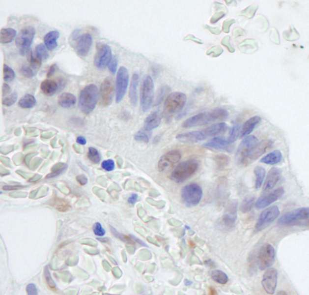 RNF20 Antibody - Detection of Human RNF20 by Immunohistochemistry. Sample: FFPE section of human ovarian carcinoma. Antibody: Affinity purified rabbit anti-RNF20 used at a dilution of 1:250. Detection: DAB staining using anti-Rabbit IHC antibody at a dilution of 1:100.
