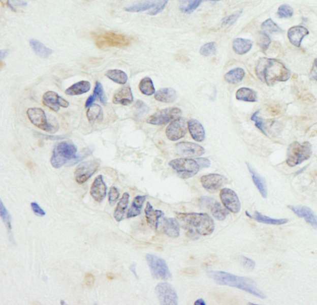 RNF20 Antibody - Detection of Human RNF20 by Immunohistochemistry. Sample: FFPE section of human prostate carcinoma. Antibody: Affinity purified rabbit anti-RNF20 used at a dilution of 1:250. Detection: DAB staining using anti-Rabbit IHC antibody at a dilution of 1:100.