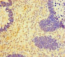 RNF20 Antibody - Immunohistochemistry of paraffin-embedded human ovarian cancer at dilution of 1:100