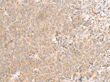 RNF207 Antibody - Immunohistochemistry of paraffin-embedded Human ovarian cancer tissue  using RNF207 Polyclonal Antibody at dilution of 1:40(×200)