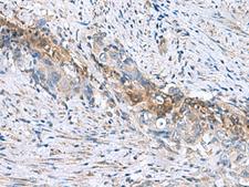 RNF208 Antibody - Immunohistochemistry of paraffin-embedded Human cervical cancer tissue  using RNF208 Polyclonal Antibody at dilution of 1:55(×200)