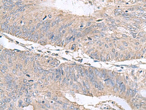 RNF208 Antibody - Immunohistochemistry of paraffin-embedded Human colorectal cancer tissue  using RNF208 Polyclonal Antibody at dilution of 1:55(×200)
