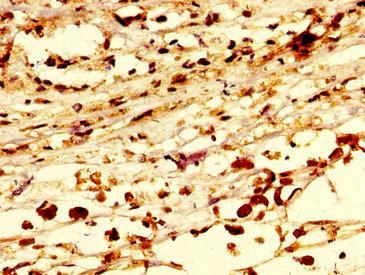 RNF219 Antibody - Immunohistochemistry image at a dilution of 1:300 and staining in paraffin-embedded human melanoma cancer performed on a Leica BondTM system. After dewaxing and hydration, antigen retrieval was mediated by high pressure in a citrate buffer (pH 6.0) . Section was blocked with 10% normal goat serum 30min at RT. Then primary antibody (1% BSA) was incubated at 4 °C overnight. The primary is detected by a biotinylated secondary antibody and visualized using an HRP conjugated SP system.