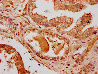 RNF220 / C1orf164 Antibody - Immunohistochemistry Dilution at 1:500 and staining in paraffin-embedded human prostate cancer performed on a Leica BondTM system. After dewaxing and hydration, antigen retrieval was mediated by high pressure in a citrate buffer (pH 6.0). Section was blocked with 10% normal Goat serum 30min at RT. Then primary antibody (1% BSA) was incubated at 4°C overnight. The primary is detected by a biotinylated Secondary antibody and visualized using an HRP conjugated SP system.