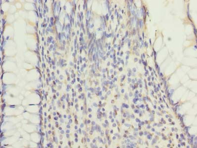 RNF26 Antibody - Immunohistochemistry of paraffin-embedded human colon cancer using antibody at dilution of 1:100.