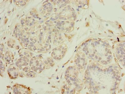 RNF26 Antibody - Immunohistochemistry of paraffin-embedded human breast cancer using antibody at dilution of 1:100.