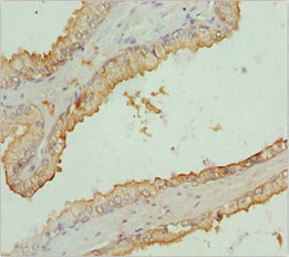 RNF34 Antibody - Immunohistochemistry of paraffin-embedded human prostate cancer at dilution 1:100