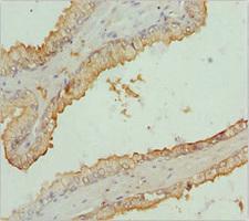 RNF34 Antibody - Immunohistochemistry of paraffin-embedded human prostate cancer at dilution 1:100