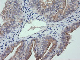 RNF39 Antibody - IHC of paraffin-embedded Adenocarcinoma of Human ovary tissue using anti-RNF39 mouse monoclonal antibody.