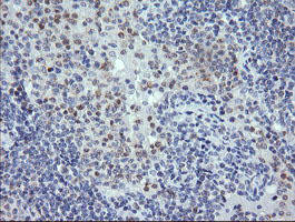 RNF39 Antibody - IHC of paraffin-embedded Human lymphoma tissue using anti-RNF39 mouse monoclonal antibody.